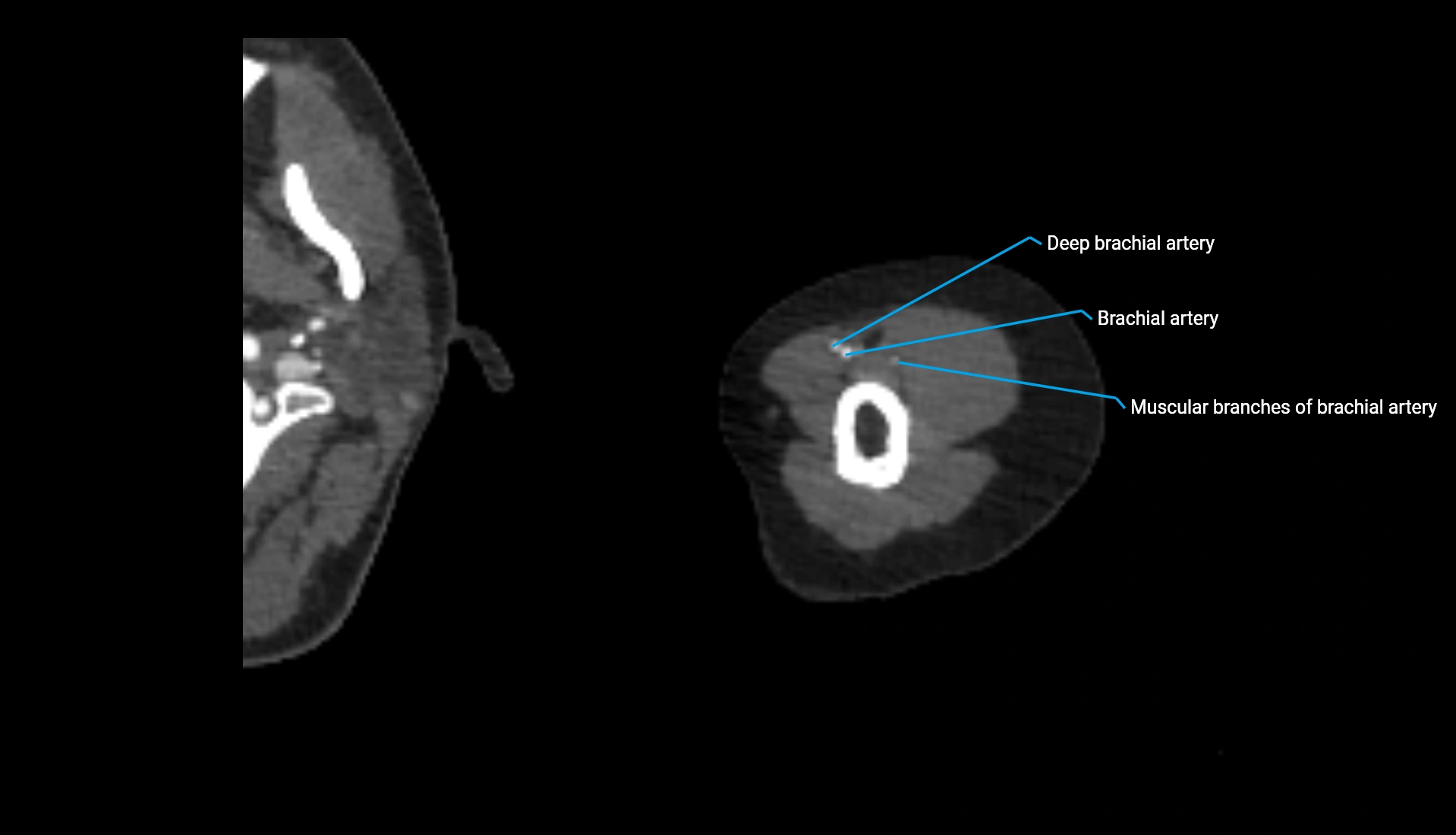 CTA upper limb axial cross sectional anatomy labelled image 278 (2).webp